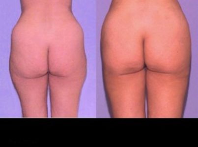 liposuction-8-300x225-1