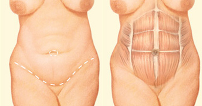 abdominoplasty1