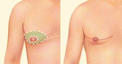 breast-reduction-men2