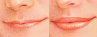 lip-augmentation2