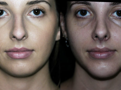 before after rhinoplasty and chin implant