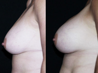 Breasts Augmentation