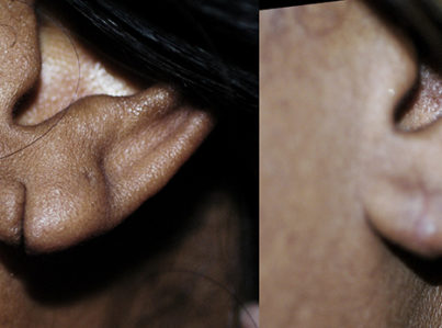 ear-lobe-repair1