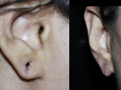 ear-lobe-repair2