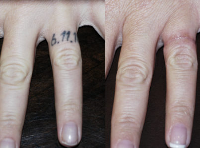 Finger Tattoo removal by surgery excision