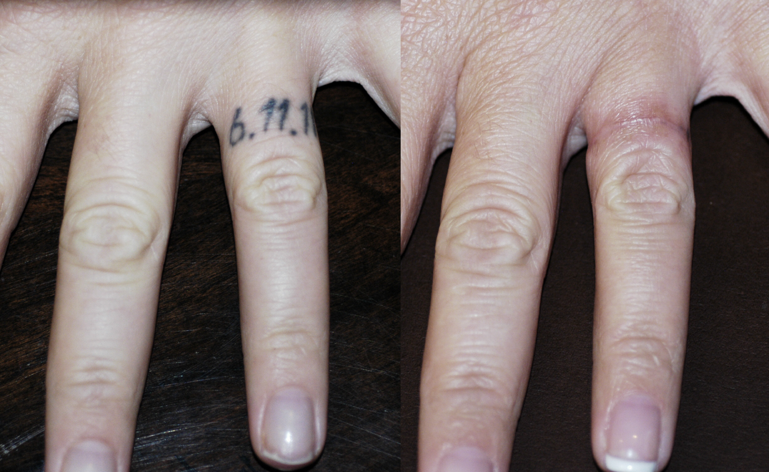 Finger Tattoo removal by surgery excision