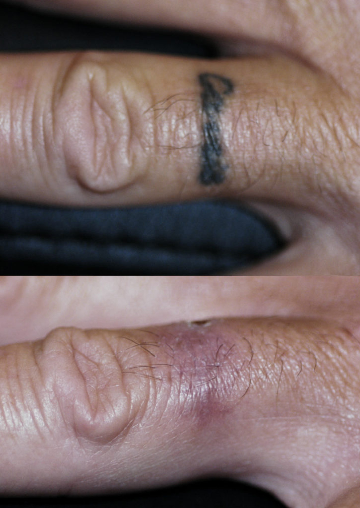remove finger tattoo by surgery - Sadove Cosmetic Surgery remove finger tattoo by surgery - Sadove Cosmetic Surgery