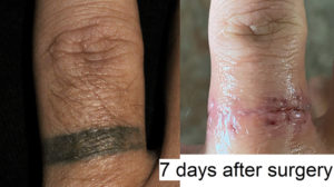 Surgical tattoo removal