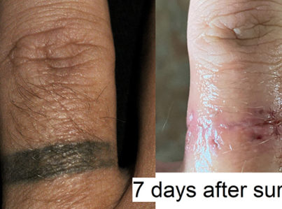Surgical tattoo removal