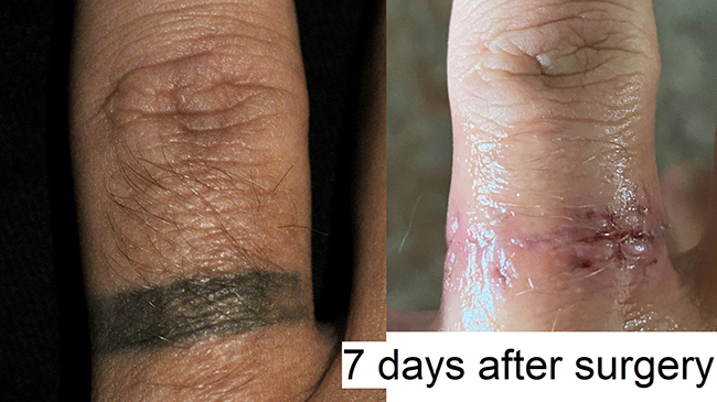 Limited Tattoo Excision | Tattoo Removal Surgery Gainesville Florida Limited Tattoo Excision | Tattoo Removal Surgery Gainesville Florida