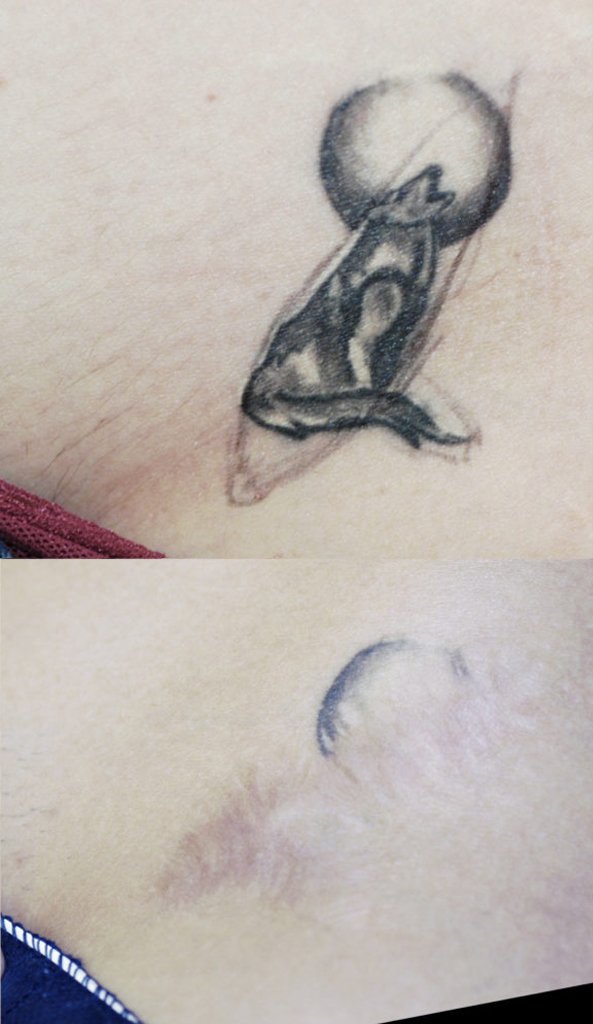 surgical tattoo removal by excision - Sadove Cosmetic Surgery surgical tattoo removal by excision - Sadove Cosmetic Surgery