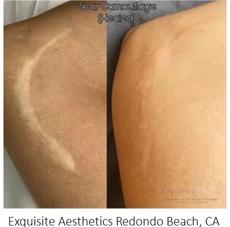 Camouflage Tattoo - Sadove Cosmetic Surgery