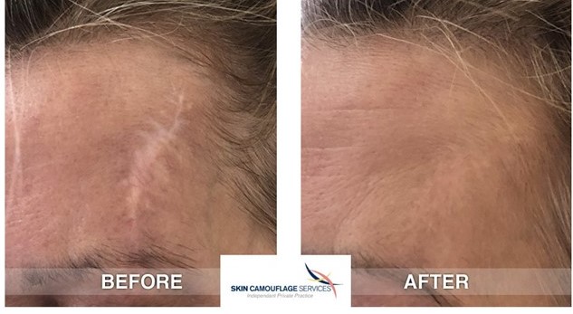 Scar Camouflage Tattoo - Sadove Cosmetic Surgery Scar Camouflage Tattoo - Sadove Cosmetic Surgery