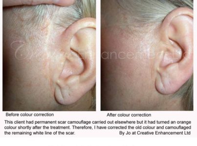 Correction of bad facelift scars