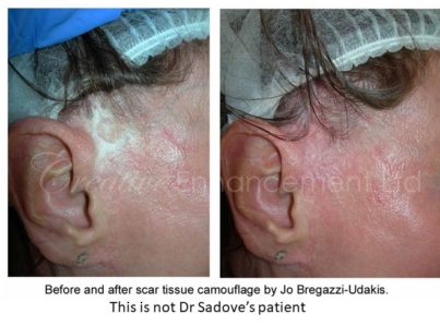 Correction of bad facelift scars