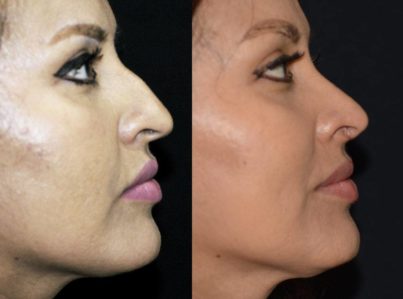 Rhinoplasty before and after