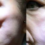 Face Fat Graft Before and After