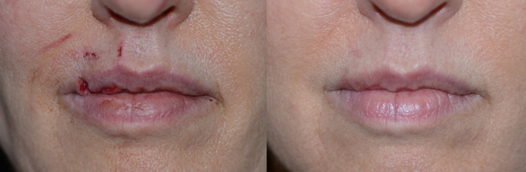 Dog bite on lip treatment on sale