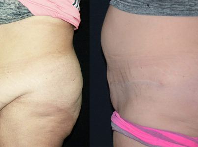 Abdomen tummy reduction panniculectomy