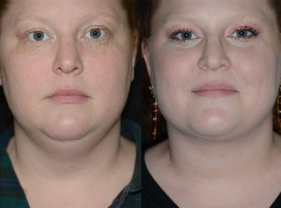 Neck Liposuction Before and After