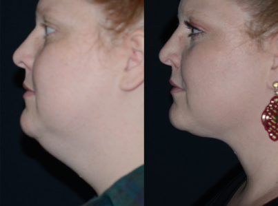 Neck Liposuction Before and After