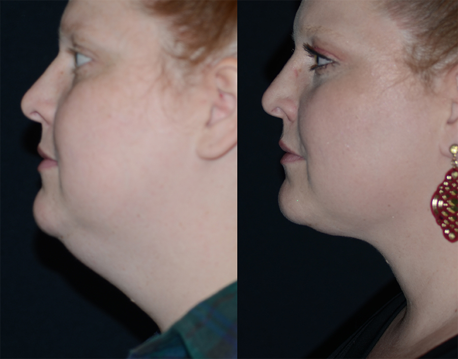 Sculpting the male jawline: Chin and neck contouring 101