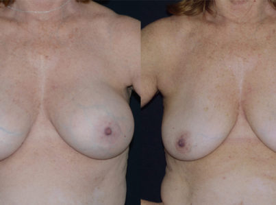 Before and After Breast Implant Removal