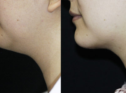 Neck Liposuction