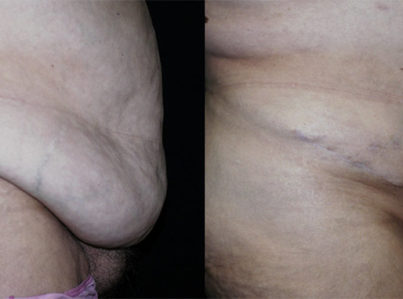 panniculectomy Removal of Pannus