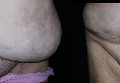 panniculectomy Removal of Pannus