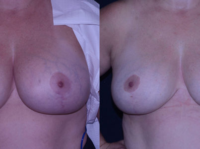 Breast Implant Removal Local Anesthesia in Office