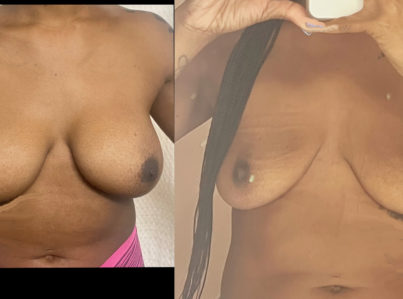 Breast implant removal