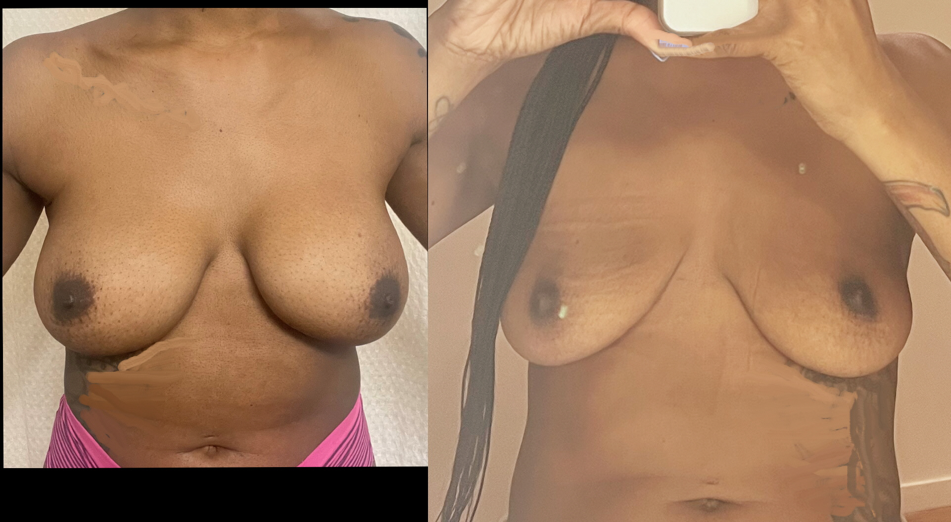 Breast implant removal