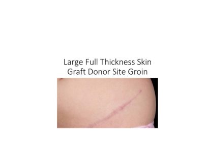 Large full thickness groin donor site as anticipated for surgical tattoo removal
