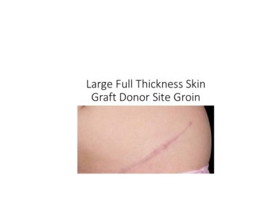 Large full thickness groin donor site as anticipated for surgical tattoo removal