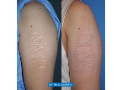 Upper Arm Split Thickness Skin Graft