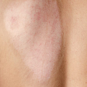 Back split Thickness Skin Graft