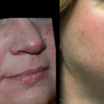 Rosacea correction with 532 nm laser