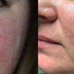 Rosacea correction with 532 nm laser