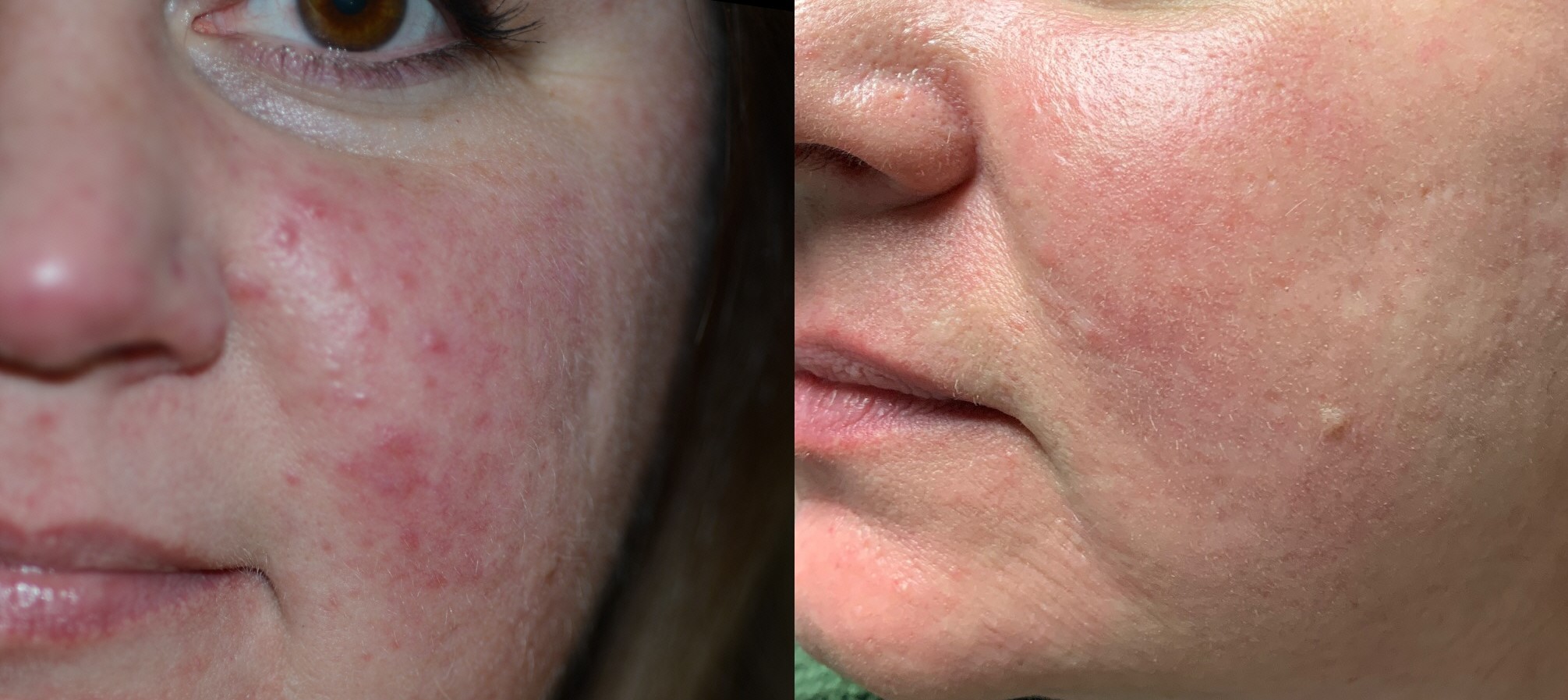 Rosacea correction with 532 nm laser