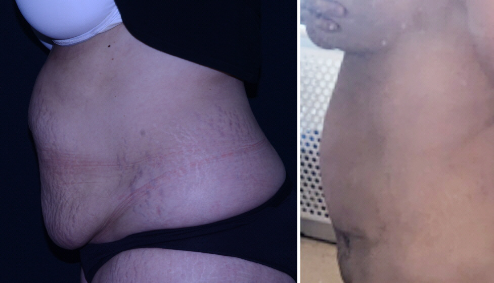 Before and after lateral view Panniculectomy - Sadove Cosmetic Surgery