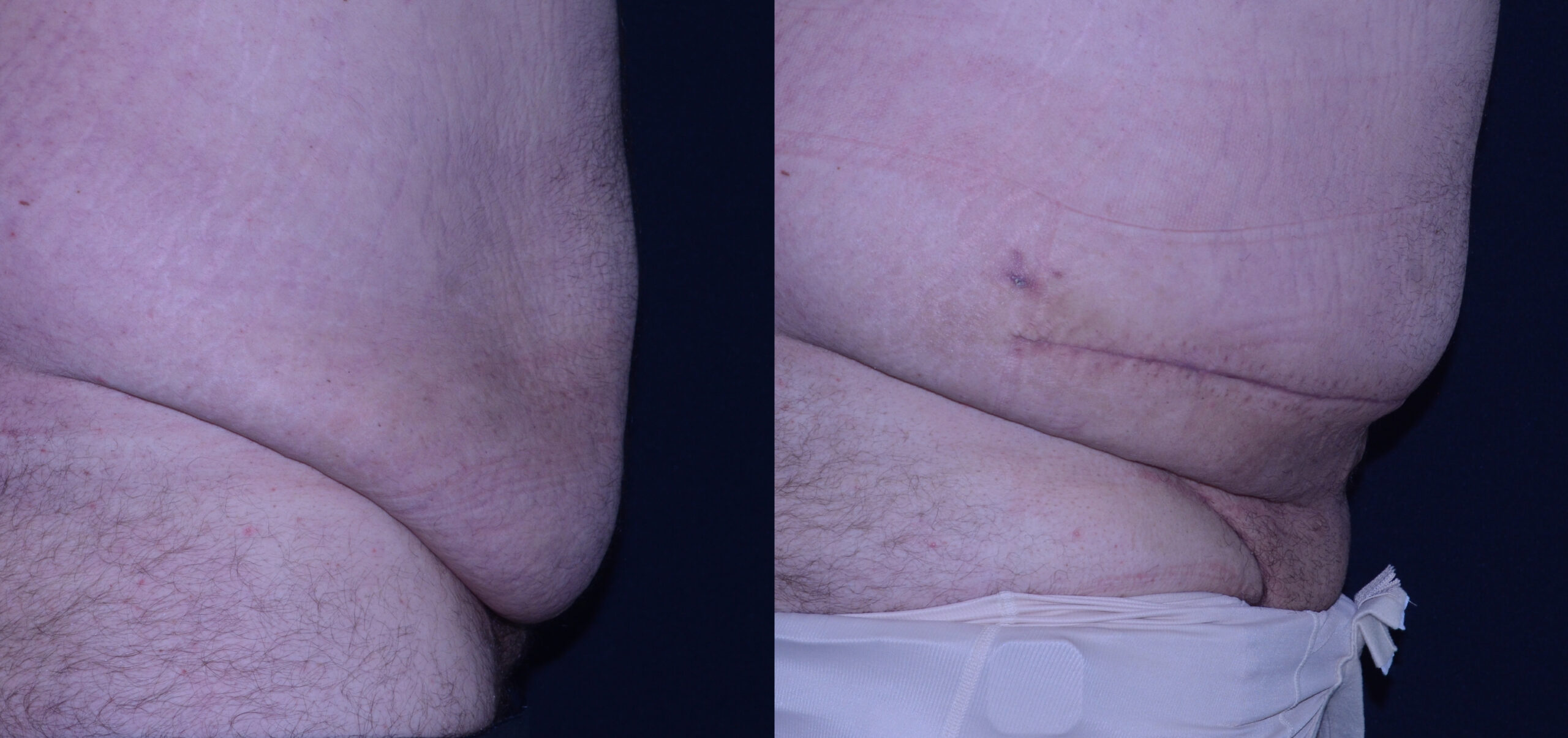 Abdominal Panniculectomy with exposure of the FUPA