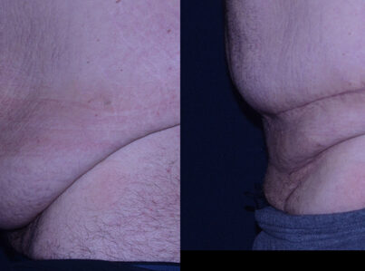 A lower abdominal skin excess can hang over the pubis or FUPA