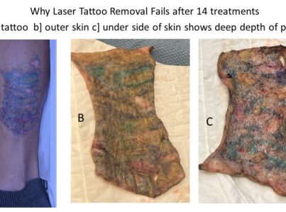 2tatremoval