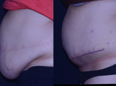 Abdominal Pannus removal before and after