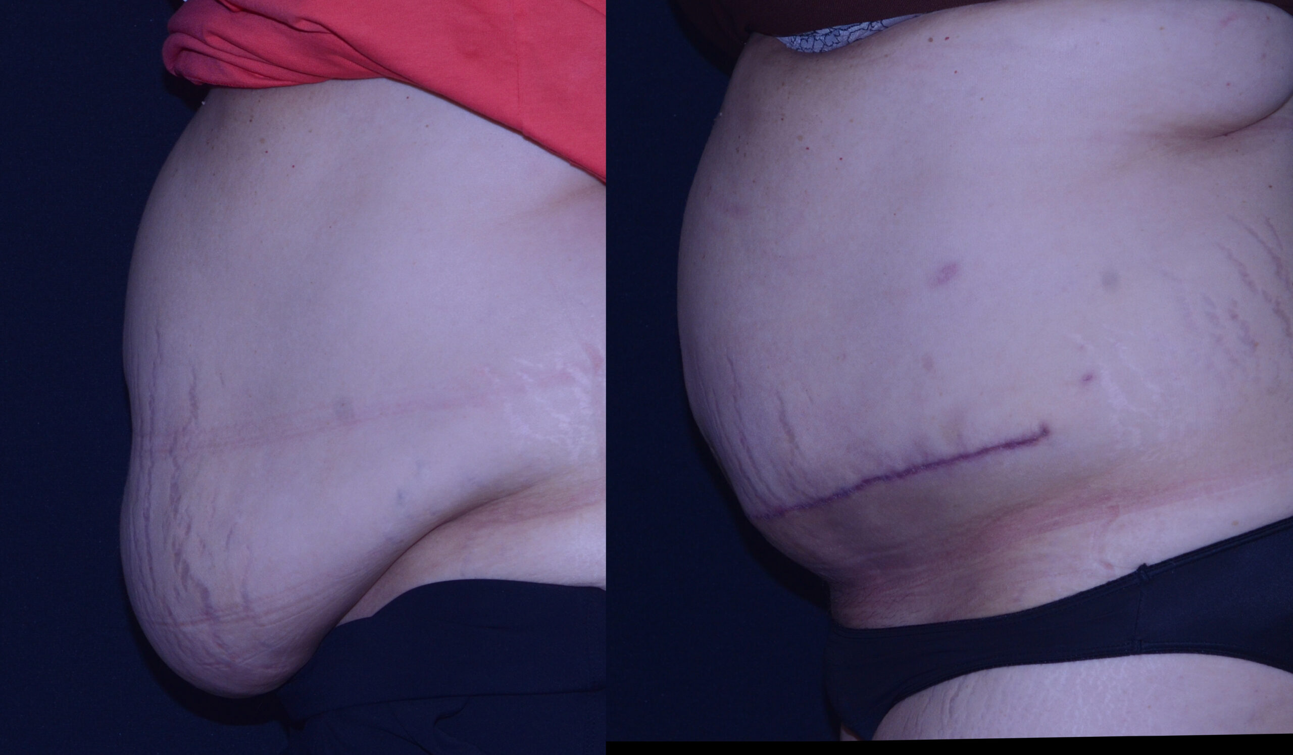 Before and after lateral view Panniculectomy - Sadove Cosmetic Surgery