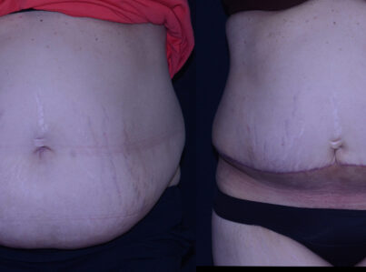 Panniculectomy before and after