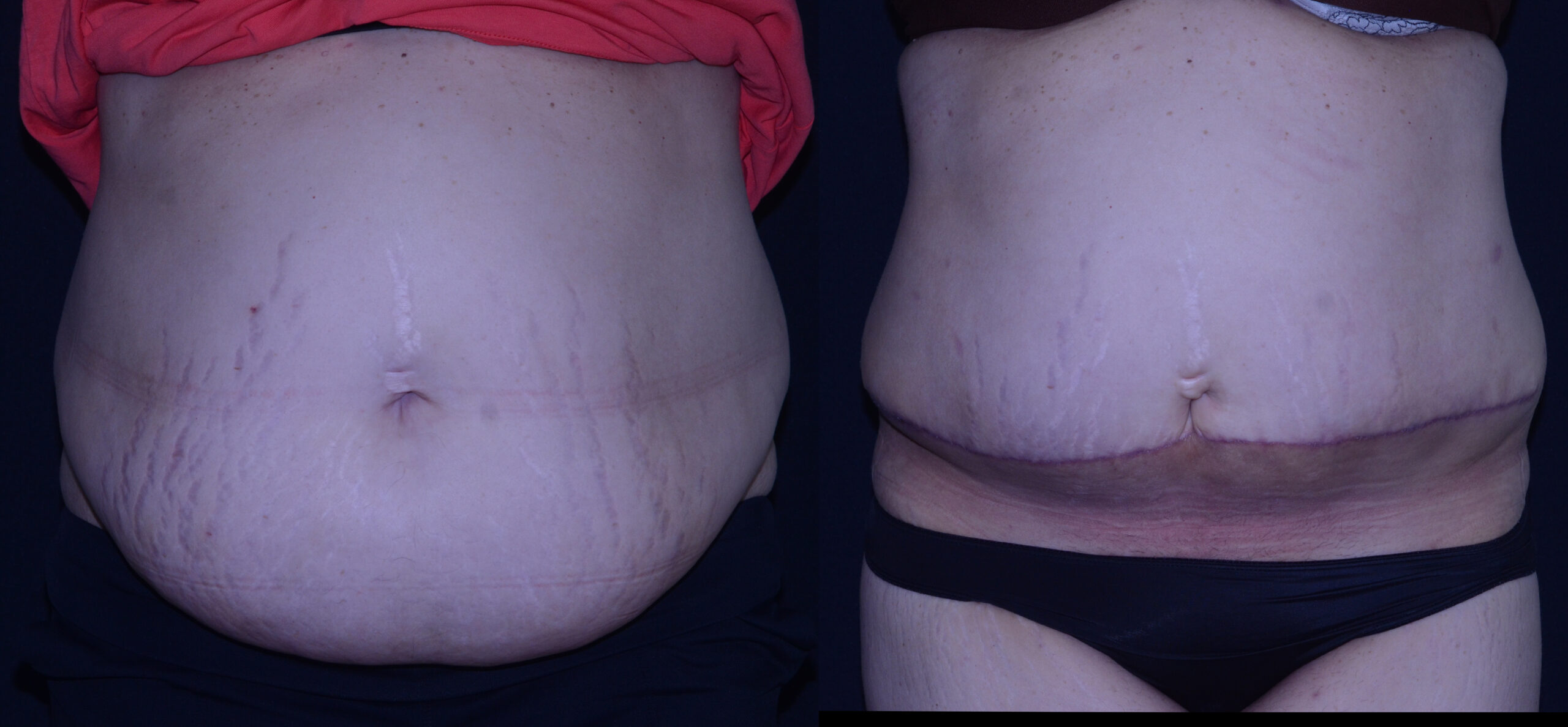 Panniculectomy before and after