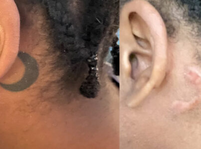 Tattoo Removal One stage