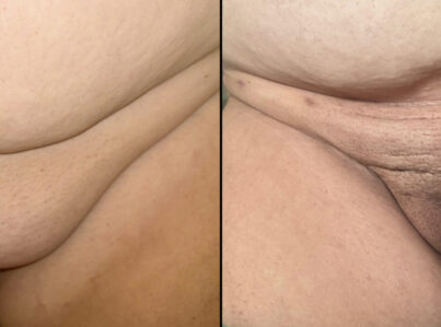 FUPA Pubic fat removal by liposuction